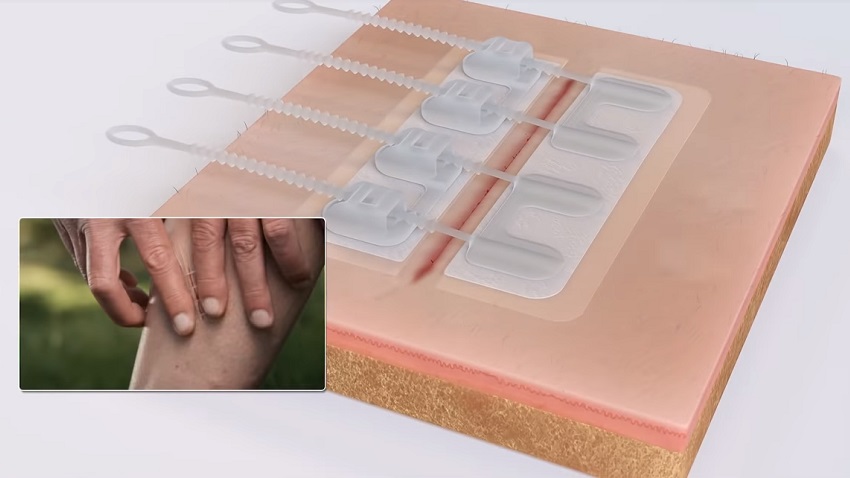 Video: चोट लगने या ऑपरेशन होने पर नहीं लगेंगे टांके, तेजी से लोकप्रिय हो रहा है ZipStitch