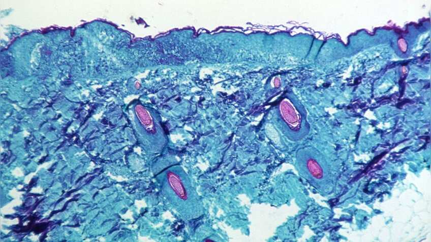 Monkeypox इन्फेक्शन के बढ़ते लक्षण से हड़कंप, WHO ने बुलाई इमरजेंसी मीटिंग, इन देशों में बढ़े मामले