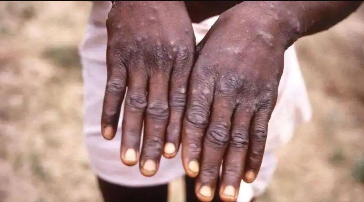 Monkeypox: मंकीपॉक्स को लेकर केंद्र अलर्ट, टास्क फोर्स का हुआ गठन