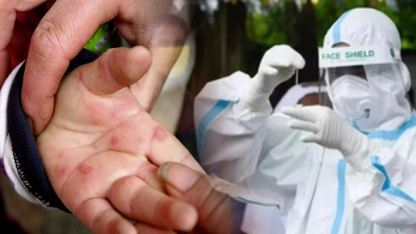 Tomato Flu: 5 साल से कम उम्र के 82 बच्चे बने शिकार! भारत में फैल रहा टोमेटो फ्लू- जानें लक्षण और बचाव