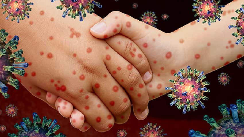Communicable Diseases हैं ग्लोबल कंसर्न, जानें भारत में किन बीमारियों के लिए हेल्थ इंश्योरेंस लेना है जरूरी – चेक करें डीटेल्स