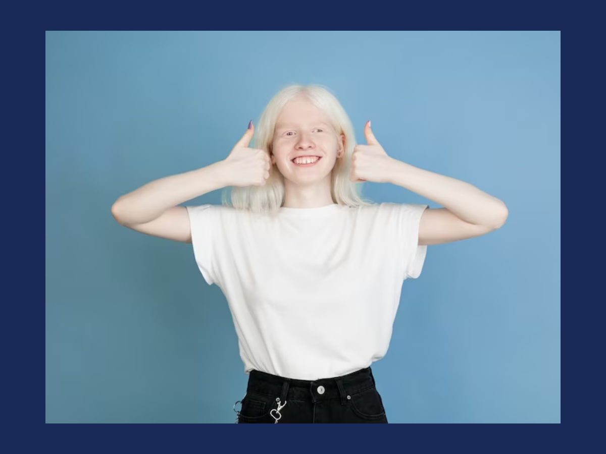 International Albinism Awareness Day 2023: छूआछूत का रोग नहीं है एल्बिनिज्म, जानें इसमें क्यों सफेद हो जाता है स्किन का रंग