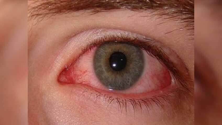 तेजी से फैल रहा Eye Flu का इंफेक्शन, जानें इसके लक्षण और बचाव के तरीके