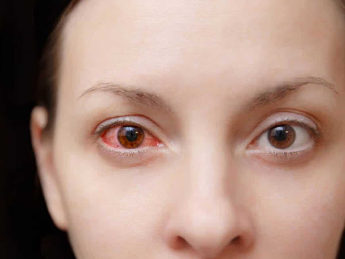 दिल्ली एनसीआर में Eye Flu और डेंगू केस में रिकॉर्ड वृद्धि, हर तीसरा बच्चे को हो रही है बीमारी