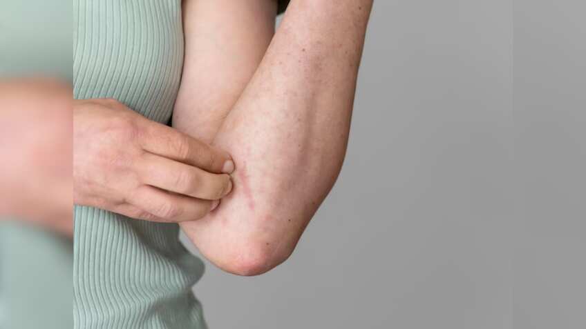 Monsoon में क्‍यों बढ़ते हैं फंगल इन्‍फेक्‍शन के मामले, जानें इससे बचने के घरेलू उपाय