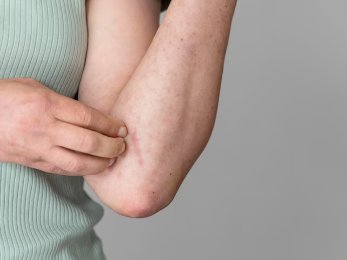 Monsoon में क्यों बढ़ते हैं फंगल इन्फेक्शन के मामले, जानें इससे बचने के घरेलू उपाय