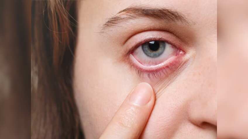 Conjunctivitis: उत्‍तराखंड में आई फ्लू के बढ़ते मामले देख अलर्ट हुई सरकार, जारी की ये गाइडलाइंस