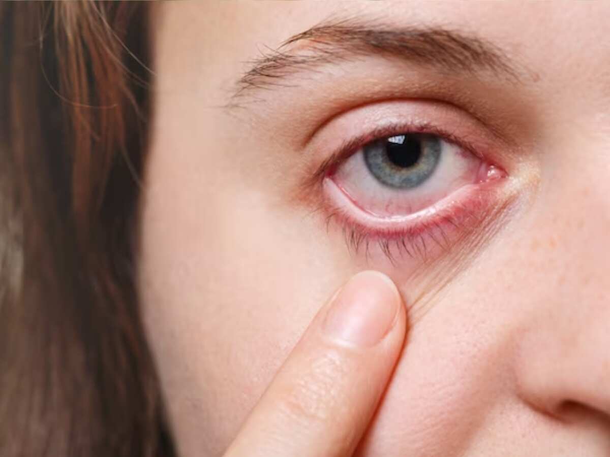 Conjunctivitis: उत्‍तराखंड में आई फ्लू के बढ़ते मामले देख अलर्ट हुई सरकार, जारी की ये गाइडलाइंस