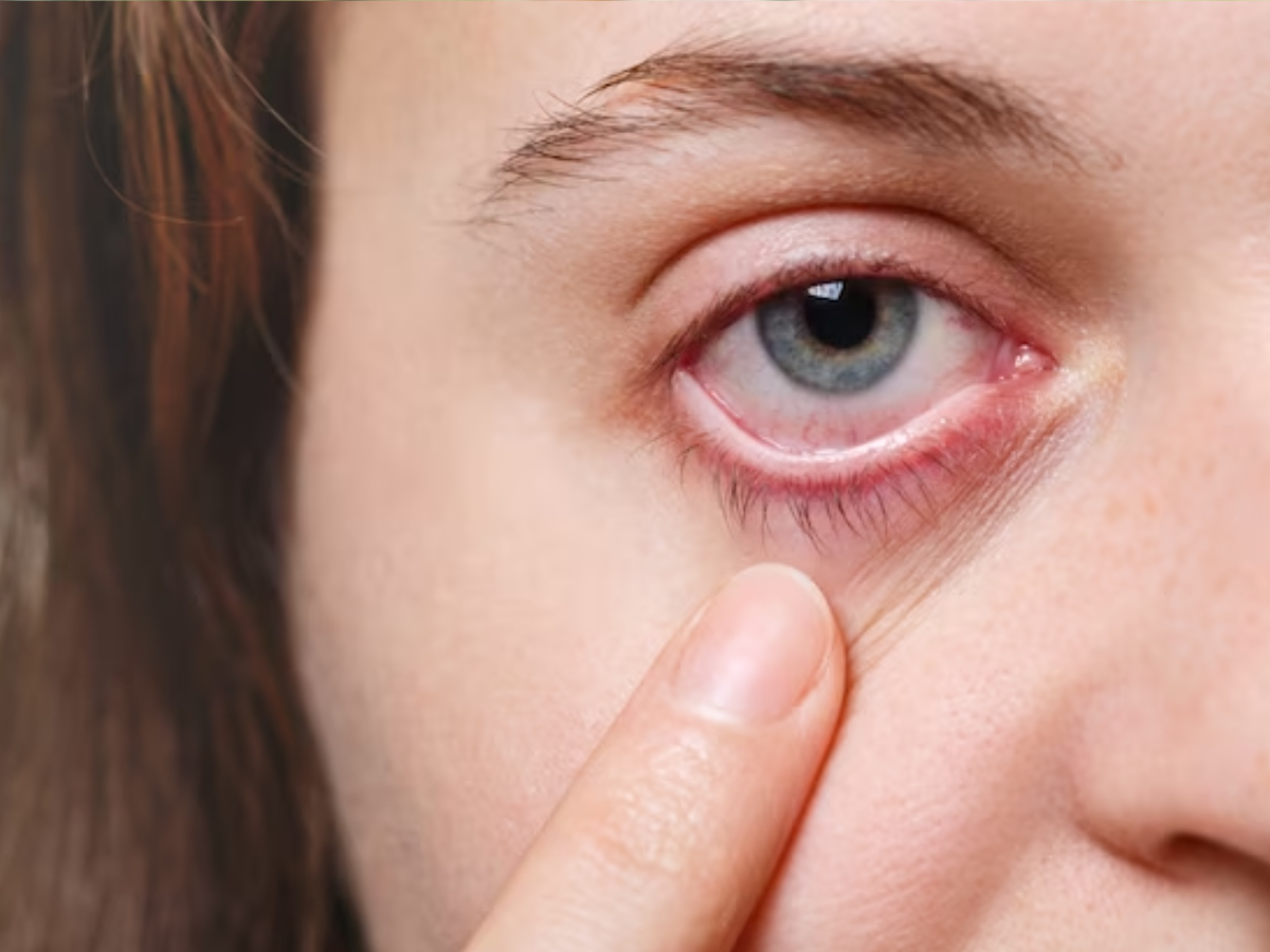 Conjunctivitis: उत्तराखंड में आई फ्लू के बढ़ते मामले देख अलर्ट हुई सरकार, जारी की ये गाइडलाइंस