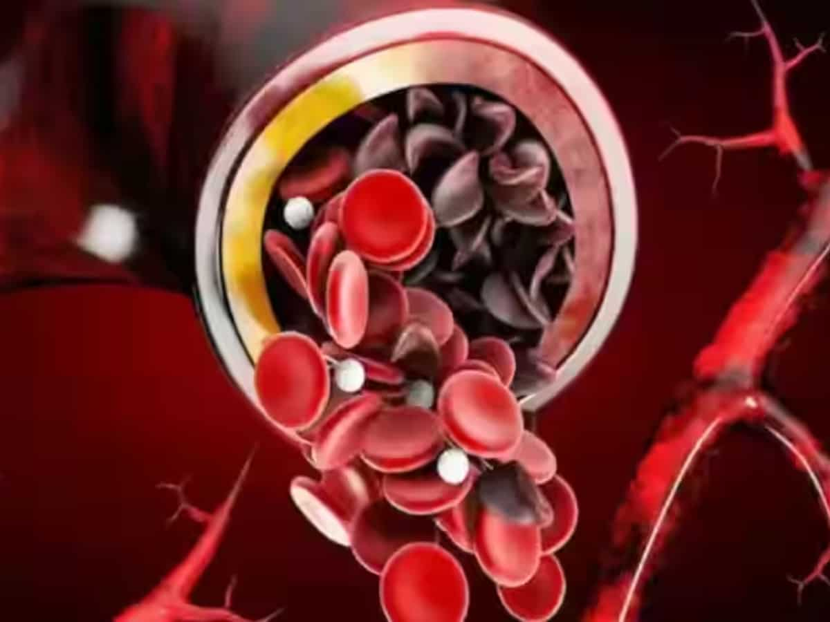 Sickle Cell Anaemia से निपटने के लिए FDA ने रोगियों के इलाज के लिए जीन थेरेपी को दी मंजूरी