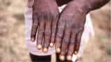 Monkeypox cases rise to over 550, infections spreading undetected: WHO