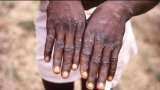 central govt formed task force to monitor monkeypox cases in india