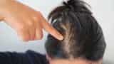 Peptides can cure hairfall and early baldness, know what are peptides and how to use it