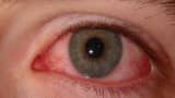 eye flu is increasing in delhi ncr know symptoms precaution treatment and home remedies