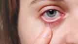Conjunctivitis eye flu pink eye viral dengue and stomach flu are increasing in Delhi ncr latest update precautions and way to prevention