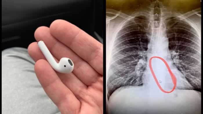 Strange: When a man swallowed Apple AirPods while sleeping, what happened next…