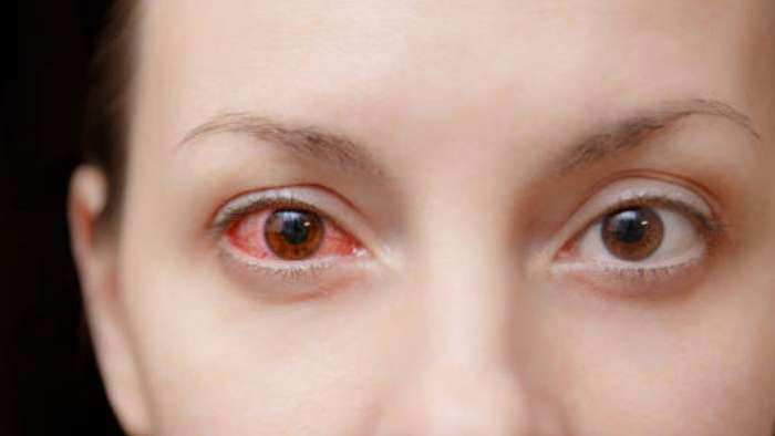 Eye Flu Conjunctivitis and Dengue cases are increasing in Delhi NCR due to this reason