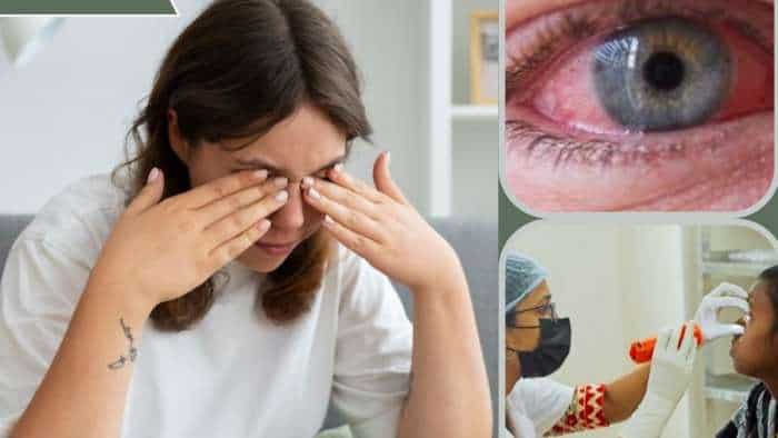 Eye Flu Conjunctivitis in Monsoon risk factors symptoms precautions and treatment check details