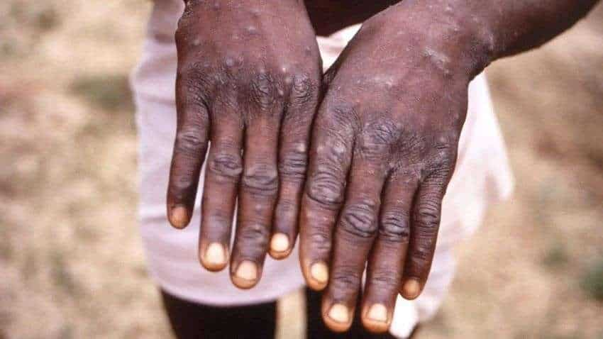 Monkeypox Virus: क्या मिल गई वैक्सीन? क्या मरीजों पर काम कर रही है दवा? मंकीपॉक्स से किन लोगों को सबसे ज्यादा खतरा