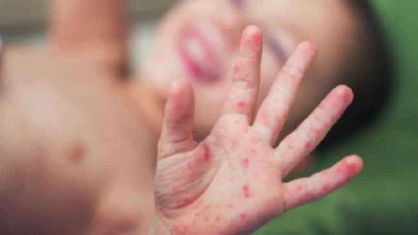 Measles: बच्चों में तेजी से फैल रहा खसरा रोग, जानलेवा हो सकता है संक्रमण- जानें लक्षण और बचाव 