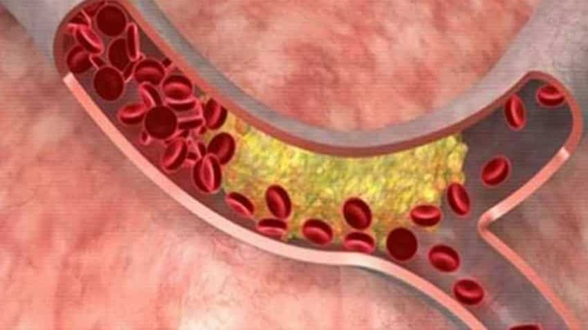 Cholesterol Symptoms: कोलेस्‍ट्रॉल बढ़ने पर आपके शरीर में दिखते हैं ये लक्षण, आपको दिखें तो फौरन हो जाएं अलर्ट