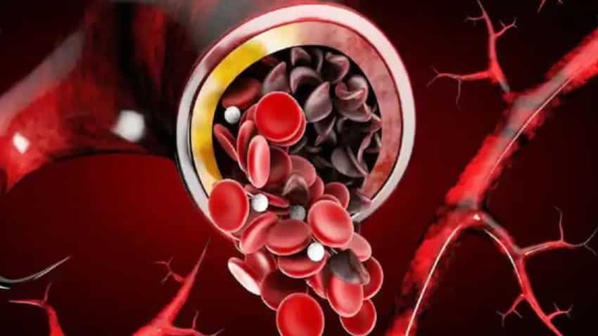 Sickle Cell Anaemia को Anaemia समझने की न करें भूल, जानें क्‍या है इनके बीच का फर्क और कितना खतरनाक है ये