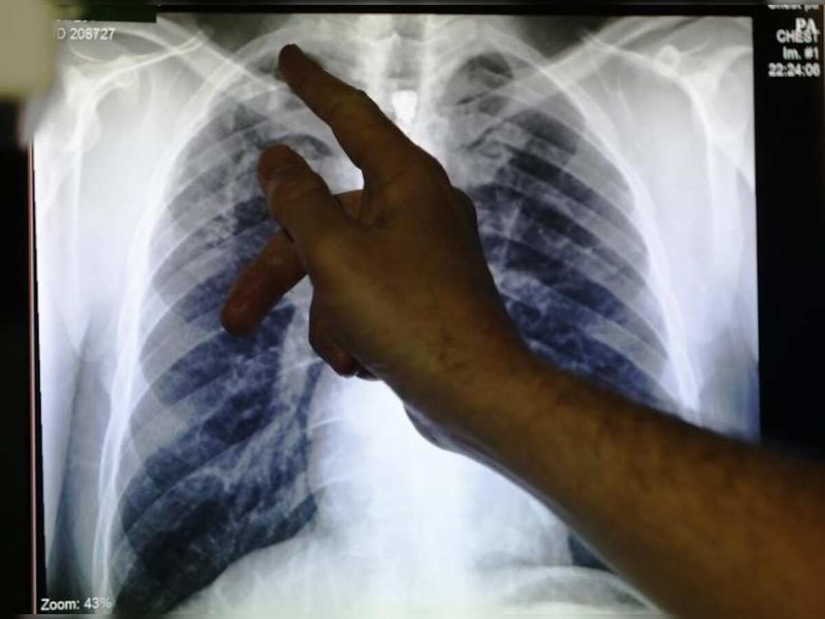 TB patients may soon get monthly &#039;social support&#039;