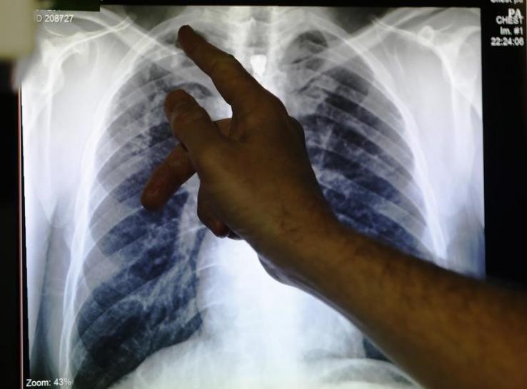 TB patients may soon get monthly 'social support'