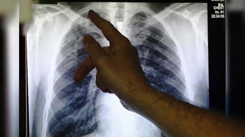 Urinary, respiratory tract infections may double stroke risk: Study