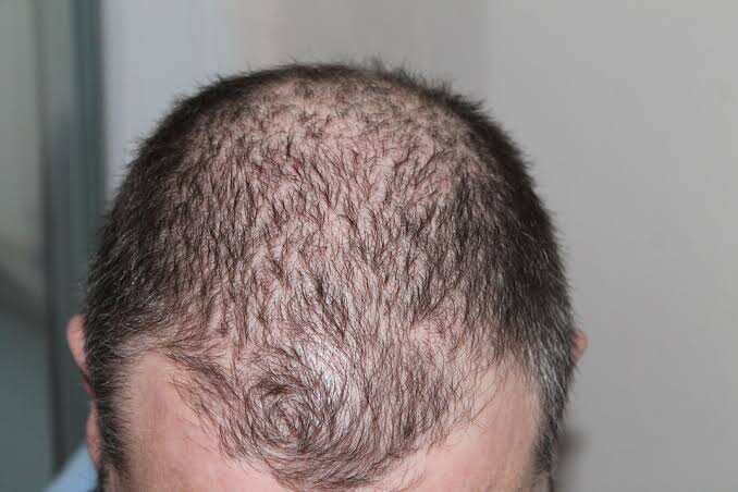 Some skin cancers may start in hair follicles: Study