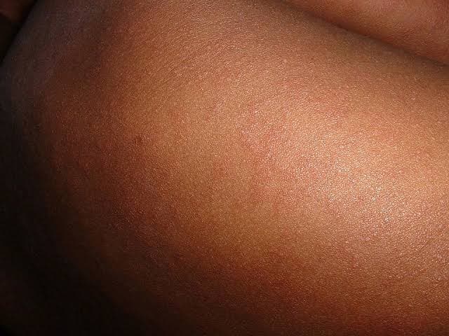 Skin allergy patients multiply in Kanpur due to pollution