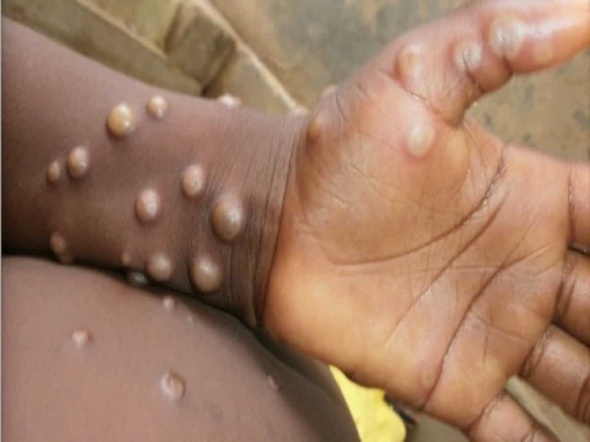 Kerala reports second monkeypox case in India amid global outbreak 