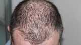 Some skin cancers may start in hair follicles: Study