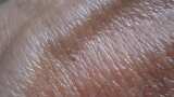 Skin Cancer: Risk Factors, Symptoms, Diagnosis and Treatment