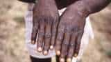 Monkeypox treatment and prevention: Dos and don'ts  