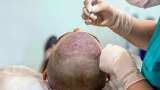 Aapki Khabar Aapka Fayda: Watching Youtube Is Not Adequate To Perform Aesthetic And Hair Transplant: NMC | Watch This Special Report