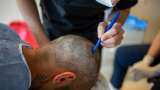Aapki Khabar Aapka Fayda: Beware Of Fake Hair Transplant Clinics! Here Are The Side Effects And Risks You Must Know Aapki Khabar Aapka Fayda: Beware Of Fake Hair Transplant Clinics! Here Are The Side Effects And Risks You Must Know