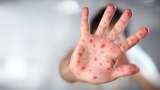 Aapki Khabar Aapka Fayda: How is measles spread and how important is vaccination? Aapki Khabar Aapka Fayda: How is measles spread and how important is vaccination?