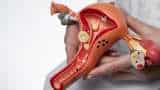 Uterine Fibroid Embolization: What is it and how does it work?