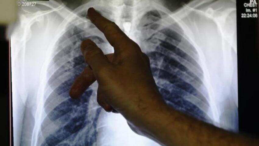 TB patients may soon get monthly 'social support' from govt TB patients may soon get monthly 'social support' from govt