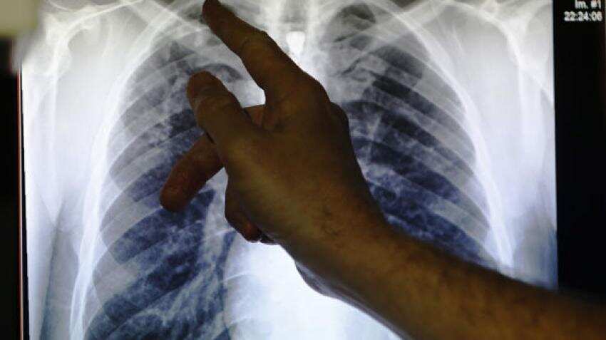 Urinary, respiratory tract infections may double stroke risk: Study Urinary, respiratory tract infections may double stroke risk: Study