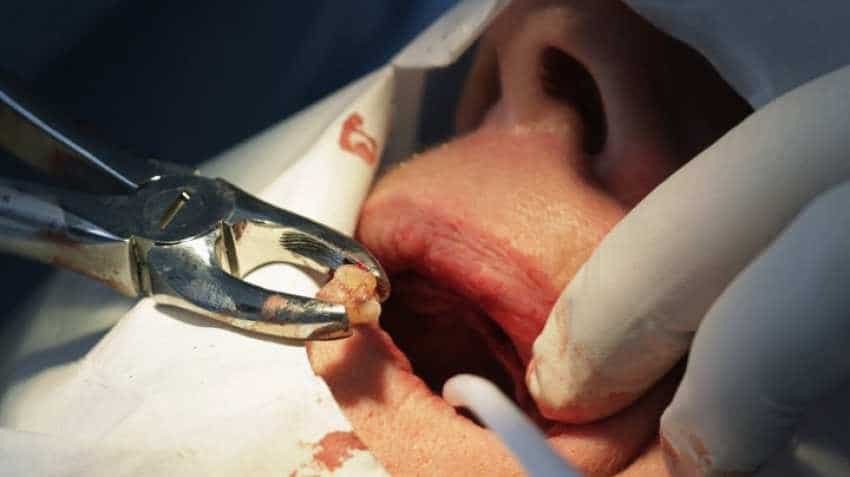 Human tooth: Chennai doctors pull 526 teeth from seven-year-old child's mouth Human tooth: Chennai doctors pull 526 teeth from seven-year-old child's mouth