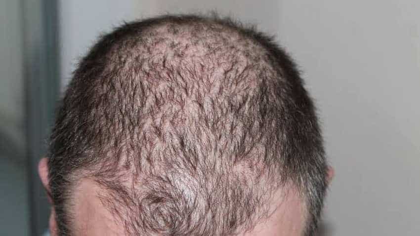 Some skin cancers may start in hair follicles: Study