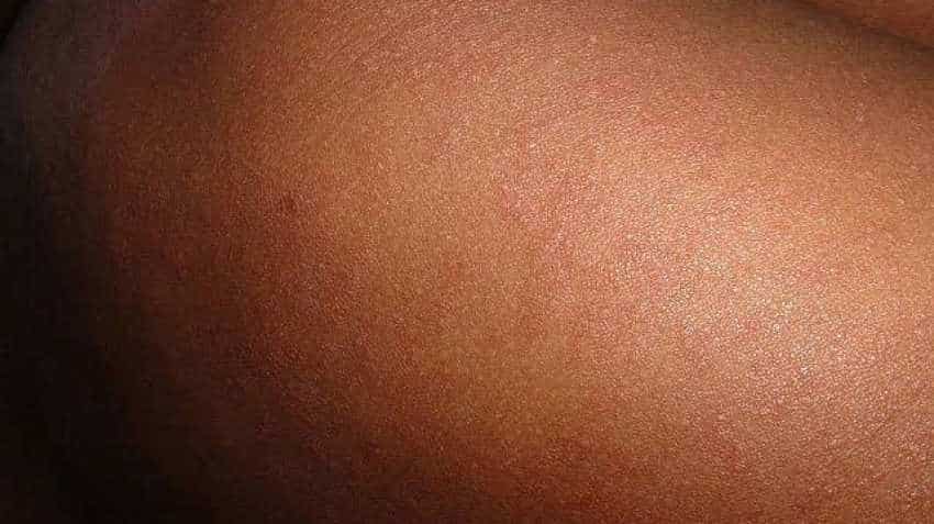 Skin allergy patients multiply in Kanpur due to pollution Skin allergy patients multiply in Kanpur due to pollution