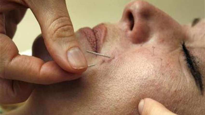 Acupuncture can be safe option to treat migraines