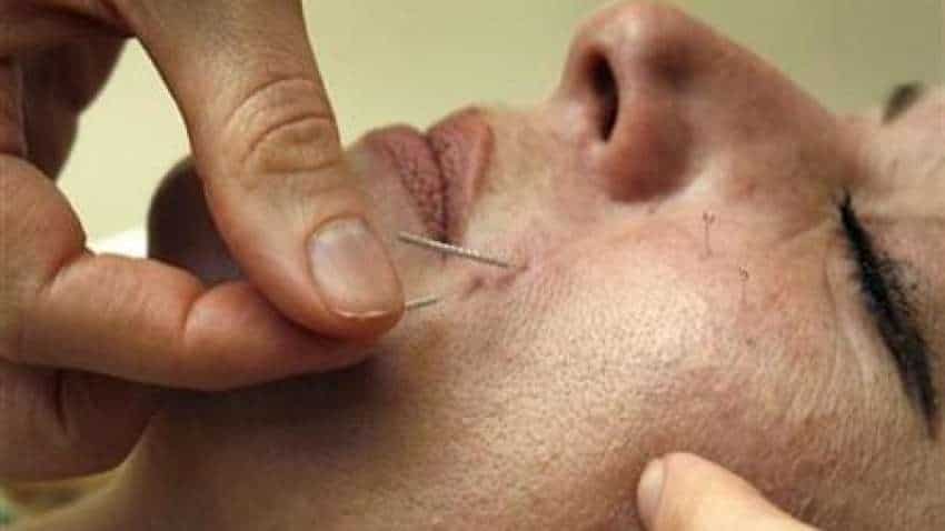 Acupuncture can be safe option to treat migraines Acupuncture can be safe option to treat migraines