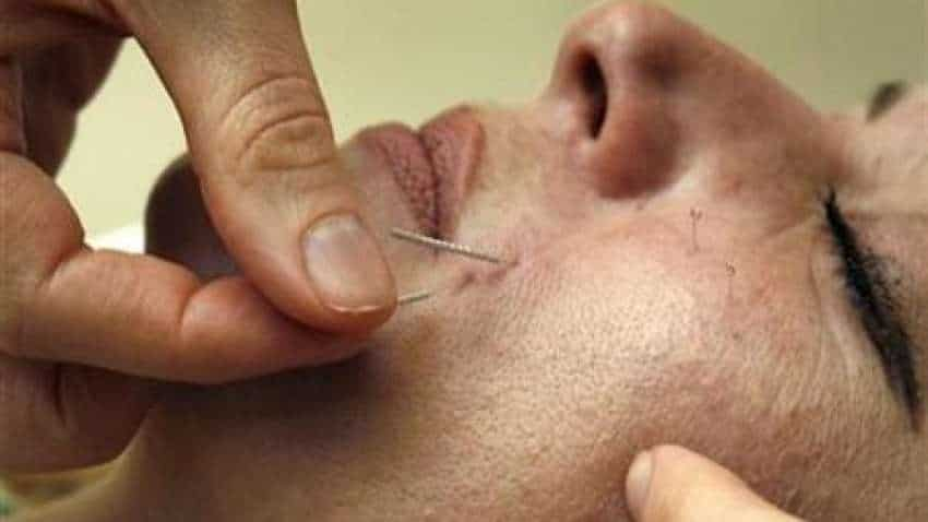 Acupuncture can be safe option to treat migraines