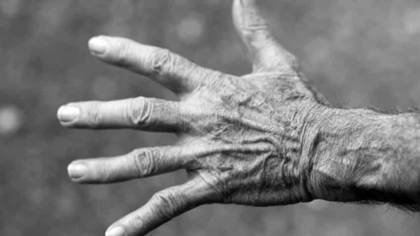 What is Rheumatoid Arthritis What is Rheumatoid Arthritis