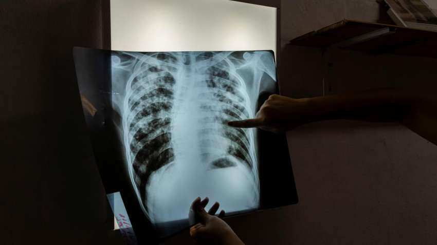 Broad measures needed to check spread of TB in India: Study Broad measures needed to check spread of TB in India: Study