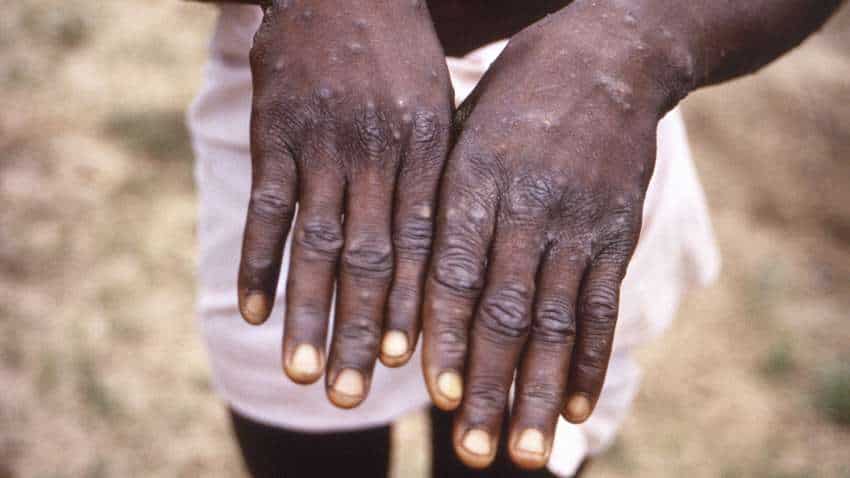 Monkeypox treatment and prevention: Dos and don&#039;ts  